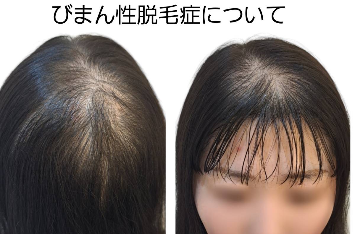 無毛症 びまん性 薄毛女性 脱毛症】若い人にも多い、びまん性脱毛症の原因と対策！！！ |  薄毛に悩む女性の為のヘアサロン・美容院｜TELAS（テラス）｜東京・大阪
